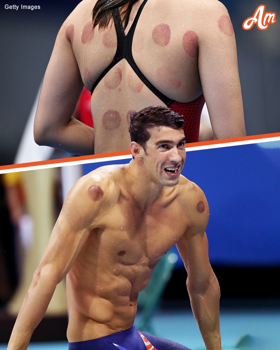 Why Were Olympic Athletes & Other Celebs Spotted with Dark Red Circles on Their Bodies?