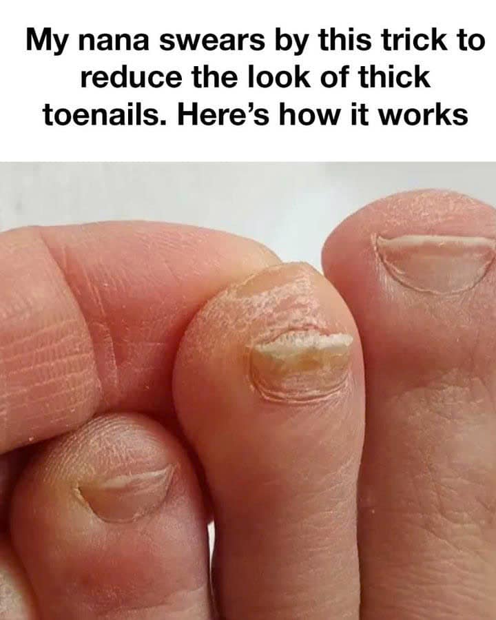 Easy Tips to Fix Thick Toenails!