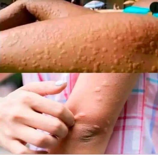  His whole body was itching, he thought it was an allergy, and he was diagnosed.… See more