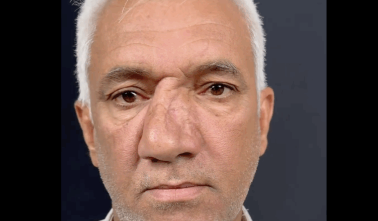 He Lived with a Rare Nose His Whole Life—Until One Decision Changed Everything…