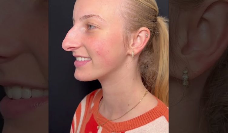 Young Woman Looks Completely Unrecognizable After Stunning Nose Job… Photos Here!