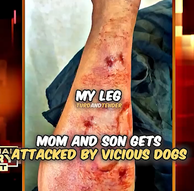 Mother and son gets attacked by viscous dogs
