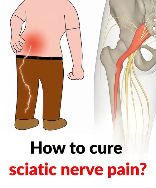 Relieve Sciatica Pain Fast: 3 Practical Exercises for Leg Pain Relief