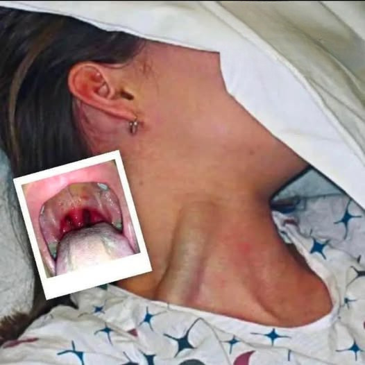 Massive jugular vein distension: a sign not to be ignored