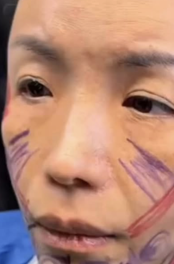 She Disappeared After a Facelift—Now Her Transformation Has the Internet Shook! 😱