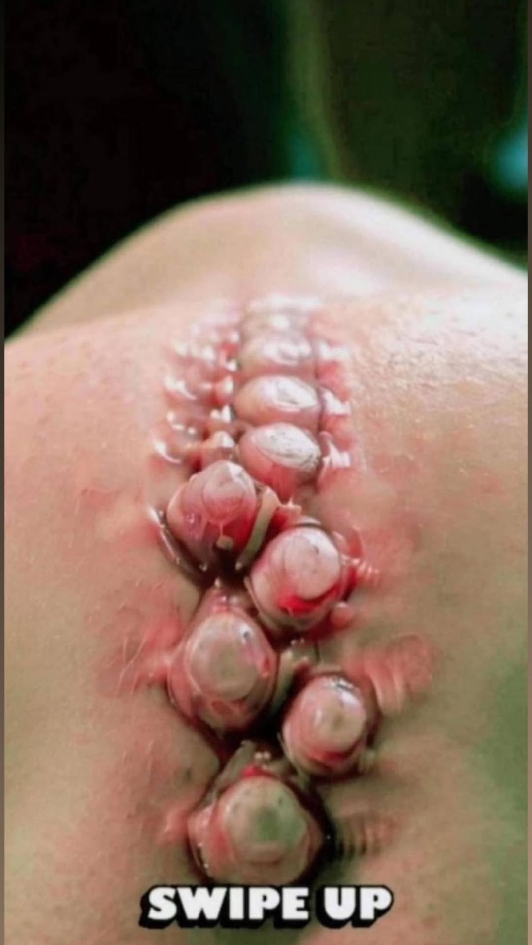Nodular Acne: Causes, Treatment, Home Remedies & More