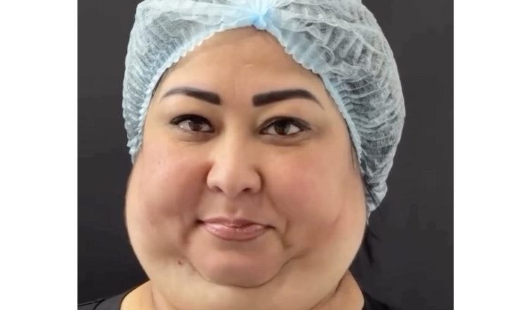 She Had Double Chin Surgery But Wait Until You See Her Jawline Now!