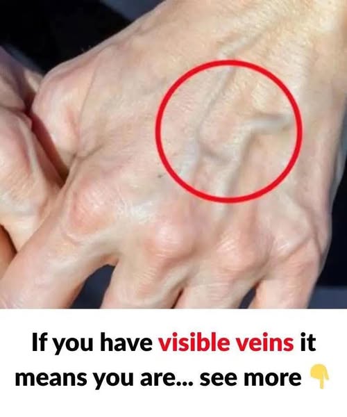 When to Worry About Veins That Appear Out of Nowhere!