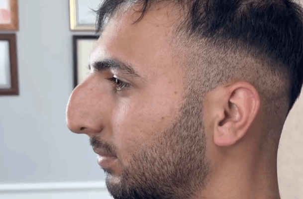 This Man With a Huge Nose Got a Surgery and Looks Unrecognizable After…
