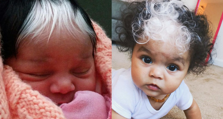 This Baby Was Born with Mysterious Hair and Skin But Here is How She Looks Years Later…