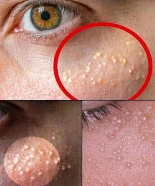 Search Results for: White Bumps on the Skin: Causes, Natural Solution, and Practical Tips