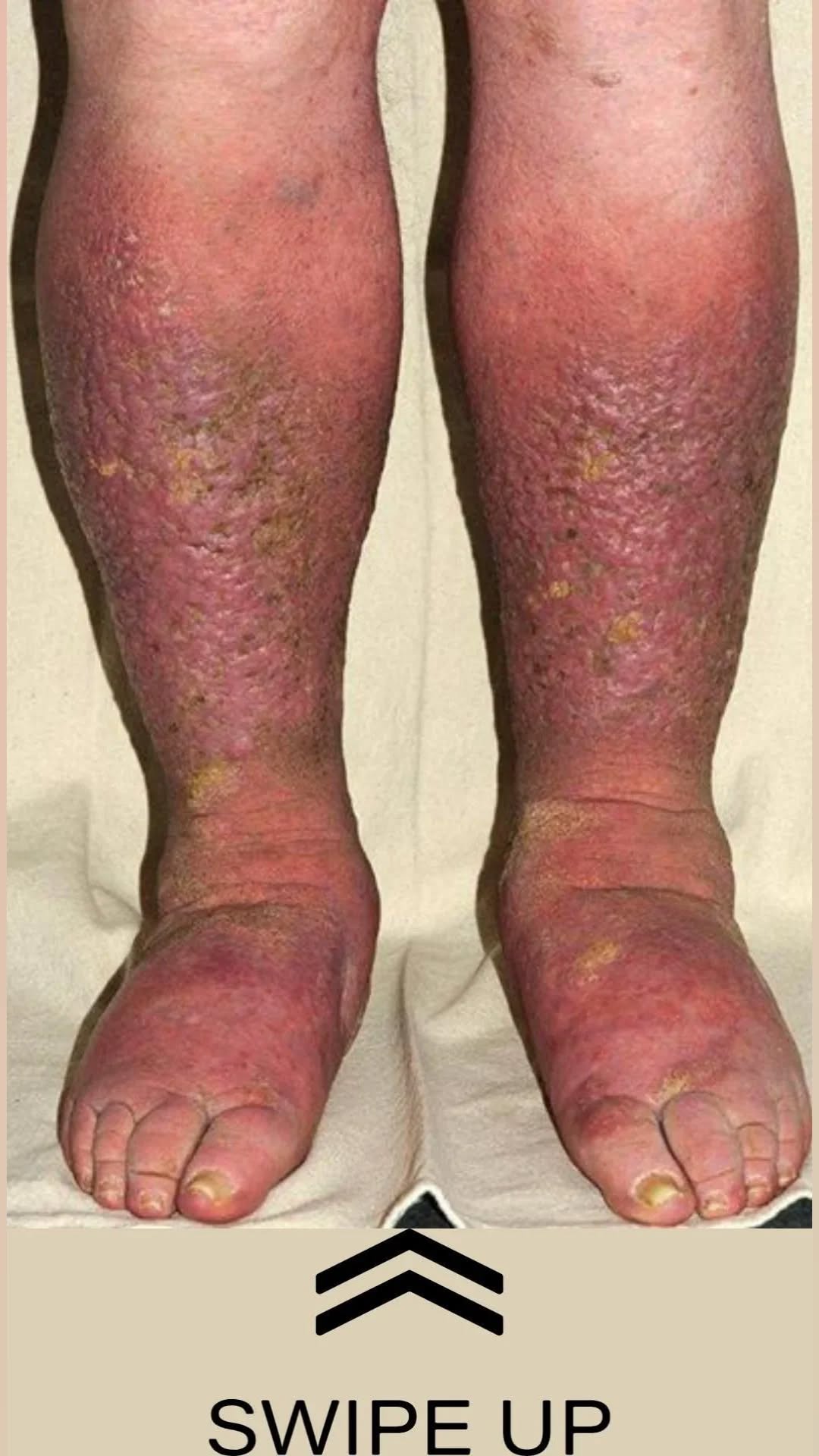 Chronic Leg Swelling and Skin Discoloration: A Serious Warning Sign You Shouldn’t Ignore
