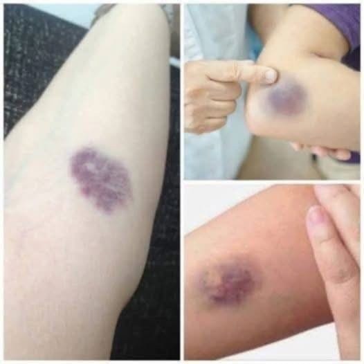 BE CAREFUL, if you get these bruises on your body, it means you have