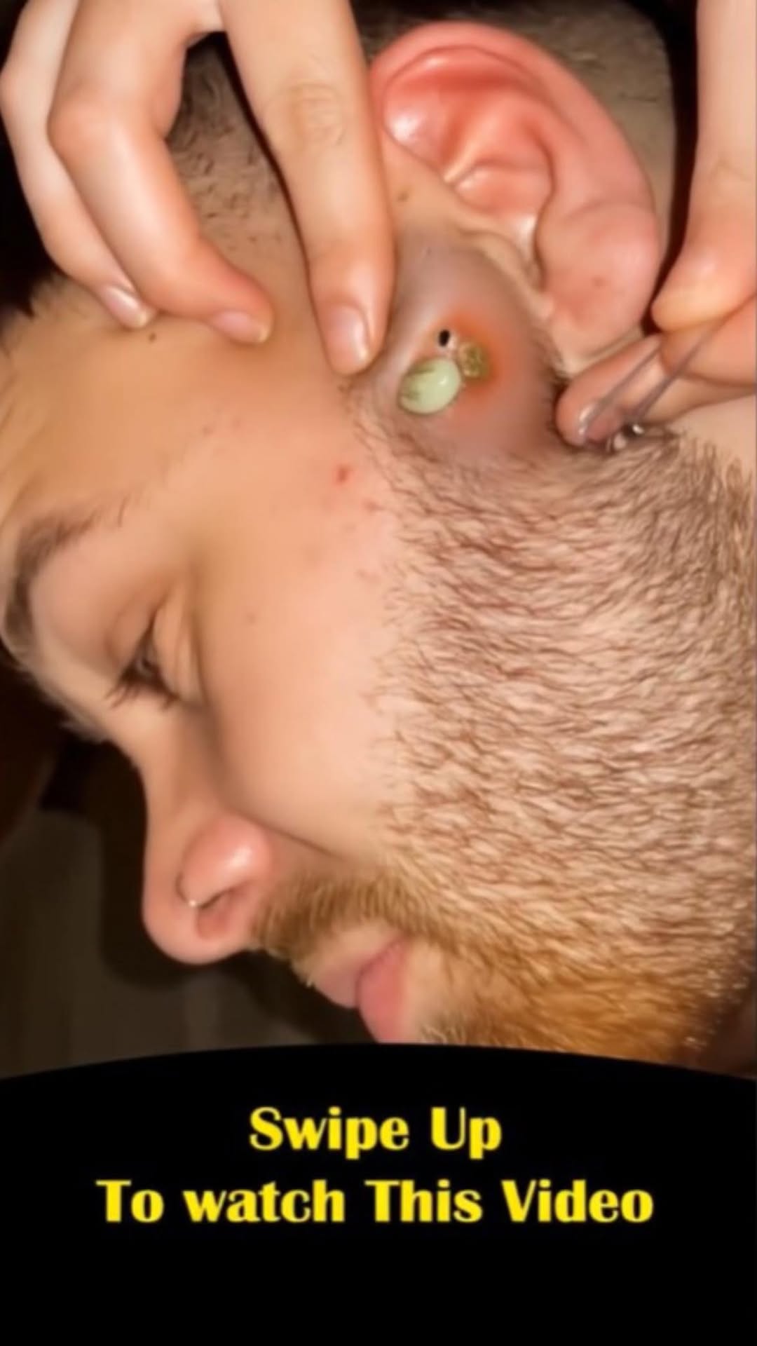 Pimple on face