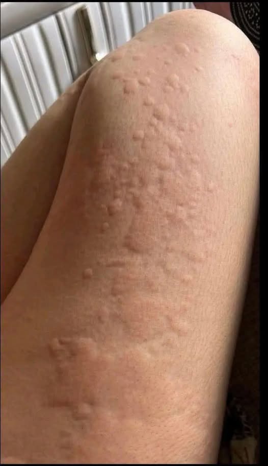 Her Whole Body Was Itchy: What She Thought Was a Common Allergy Was Hiding Something More Serious