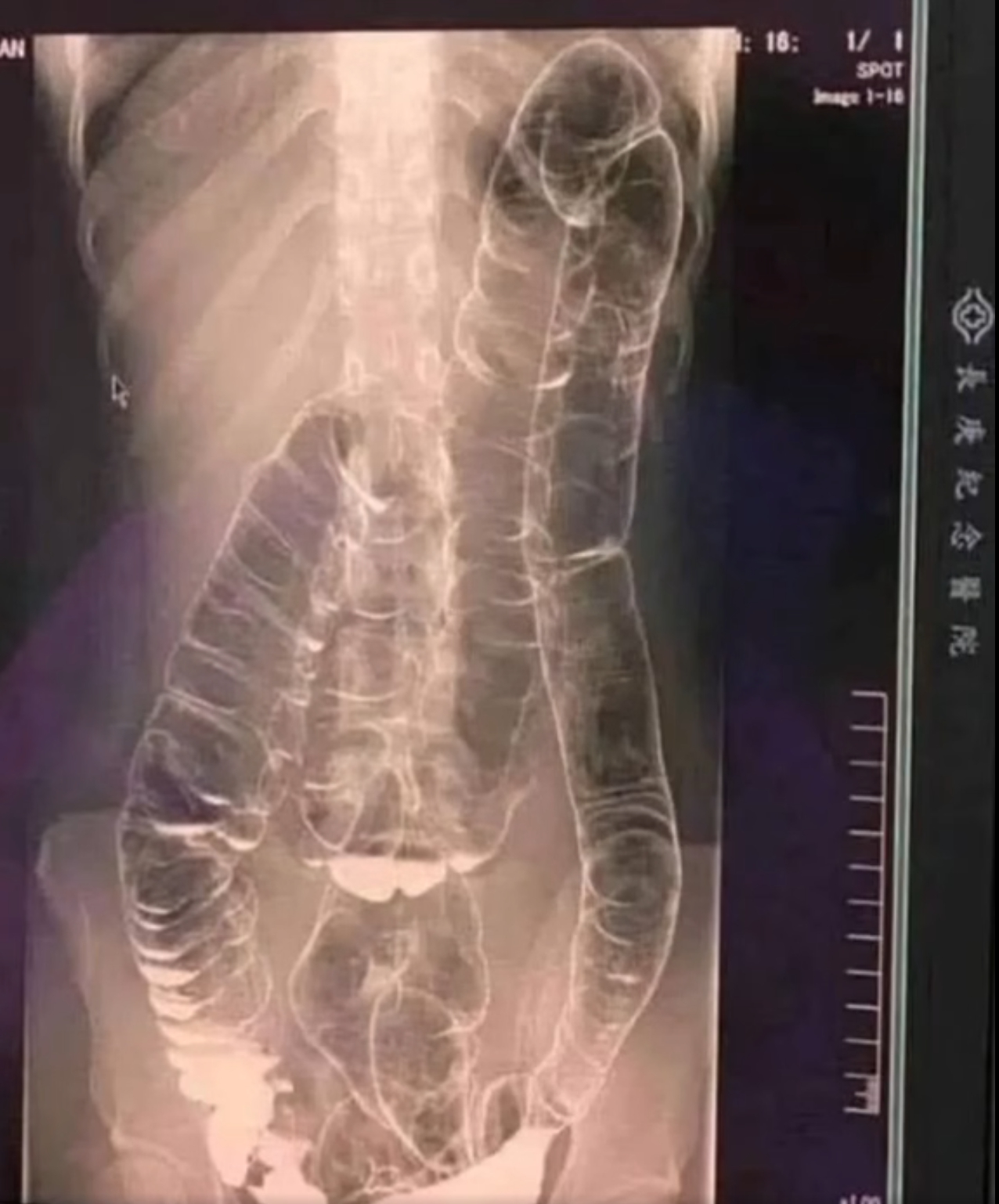 Severe Constipation and Toxic Megacolon: Causes and Solutions