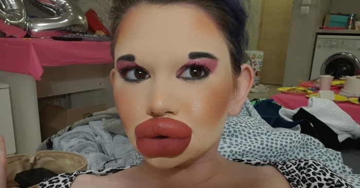 Before duck lips!» Here is what the girl with the biggest lips looked like before plastic surgery