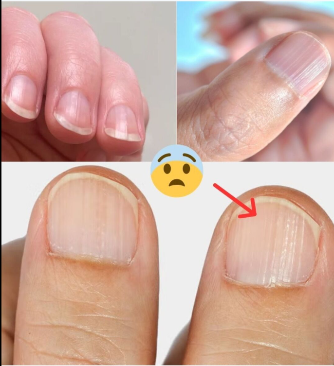 Doctor Reveals 7 Health Issues Hidden in Your Nails — What They Could Be Telling You