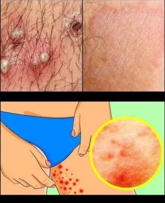 Understanding Skin Irritation in Sensitive Areas: Causes, Care, and Prevention