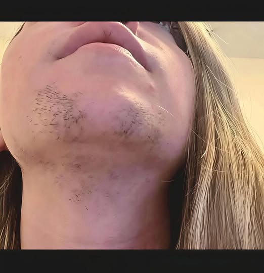 Understanding Facial Hair Growth in Women: Causes, Management, and Healthy Living Strategies