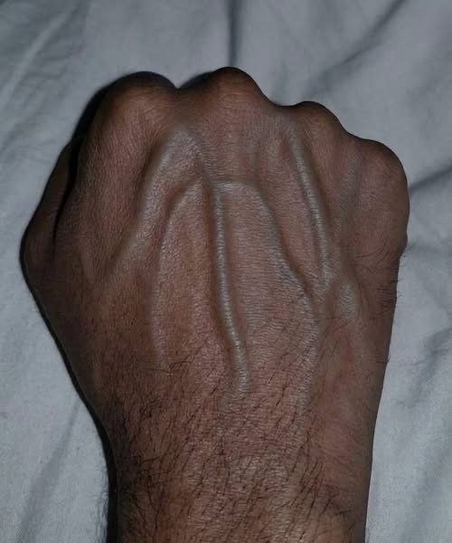 The Story Written on a Hand: What Prominent Veins Can Tell Us