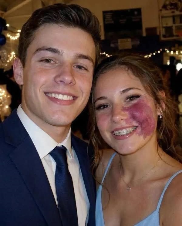 Only one boy asked me to prom because no one else wanted to go with me because of the birthmark on my face — everyone laughed until police officers walked into the gym.