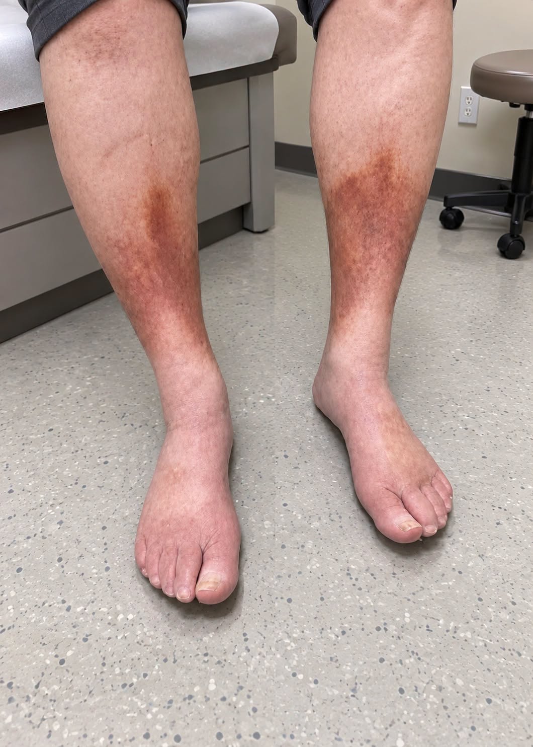 Persistent Leg Swelling and Skin Darkening: When to See a Doctor