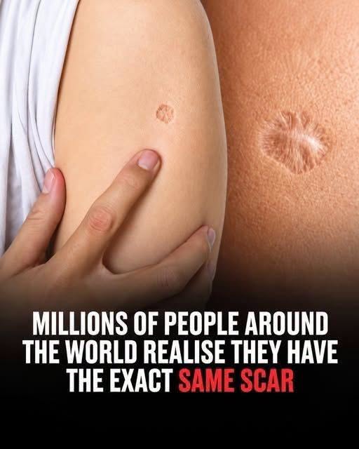 Why Do So Many People Have the Same Small Scar? The Mystery Behind a Global Mark