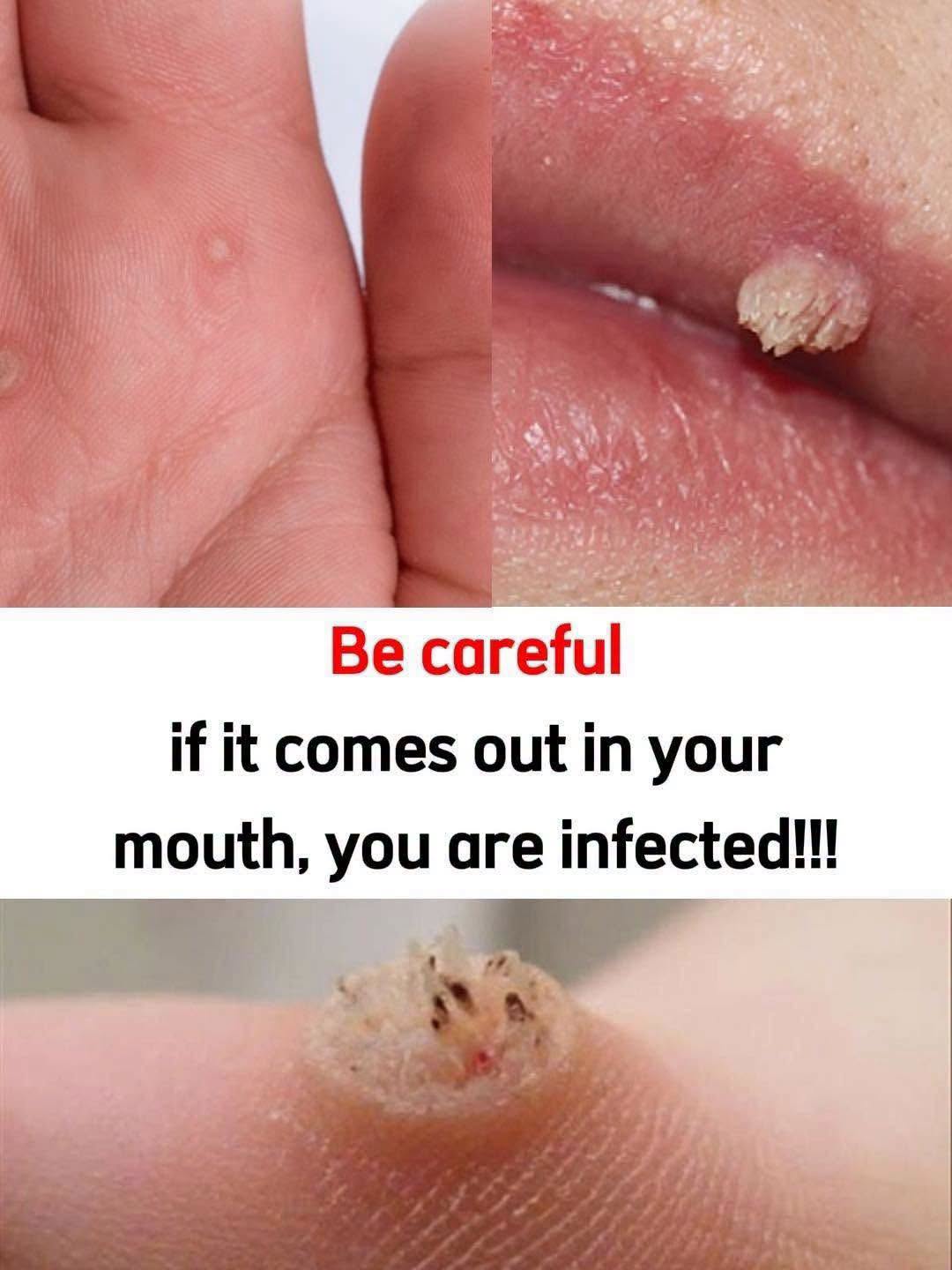 Recognizing Warts and Choosing Safer Treatment