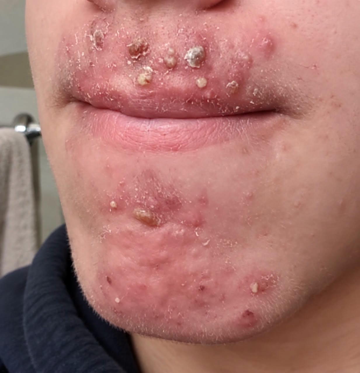 Been dating this woman I met at Walmart and after finally getting some I woke up with these on my face what is this?