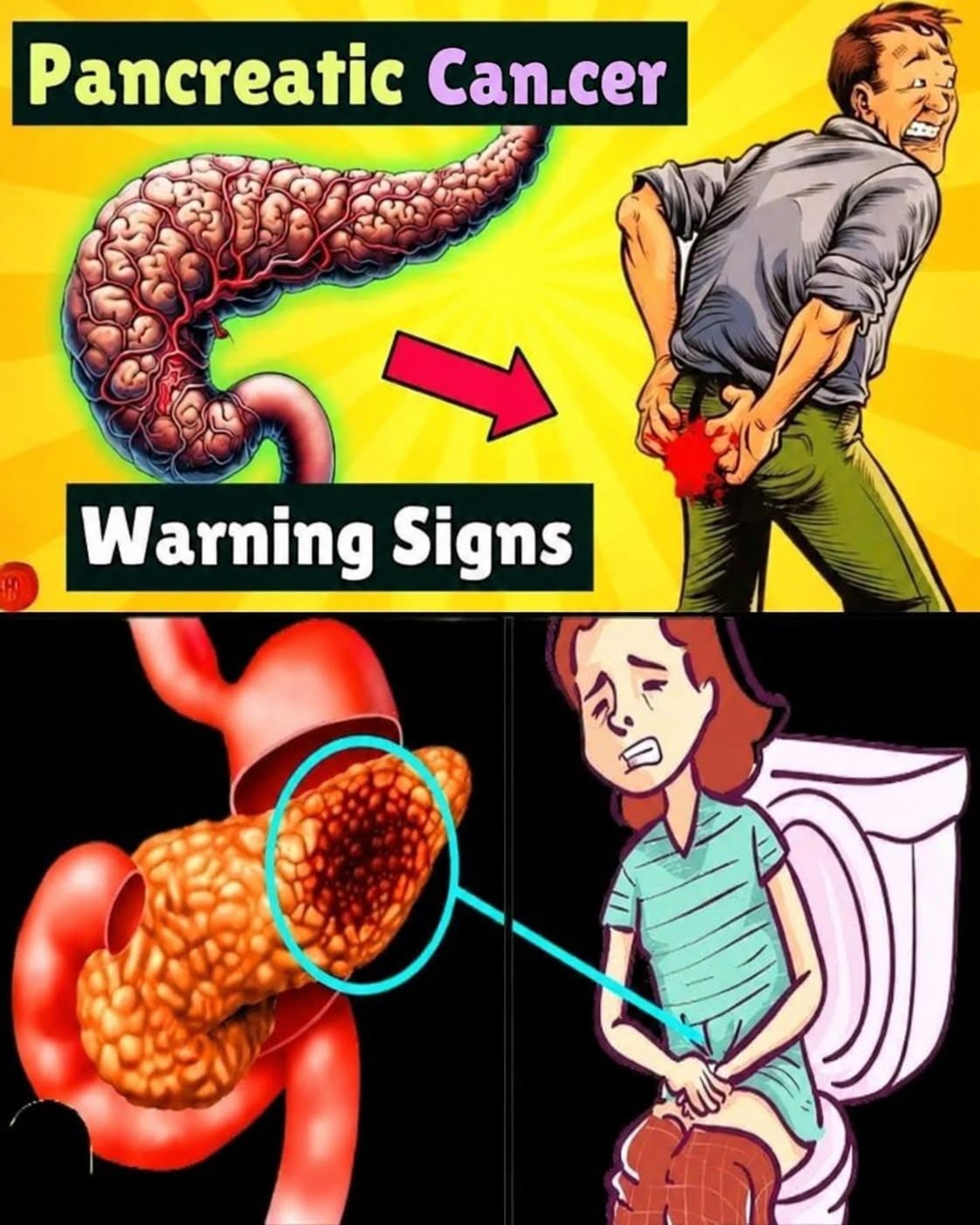 15 Silent Signs of Pancreatic Can.cer You Should Never Ignore