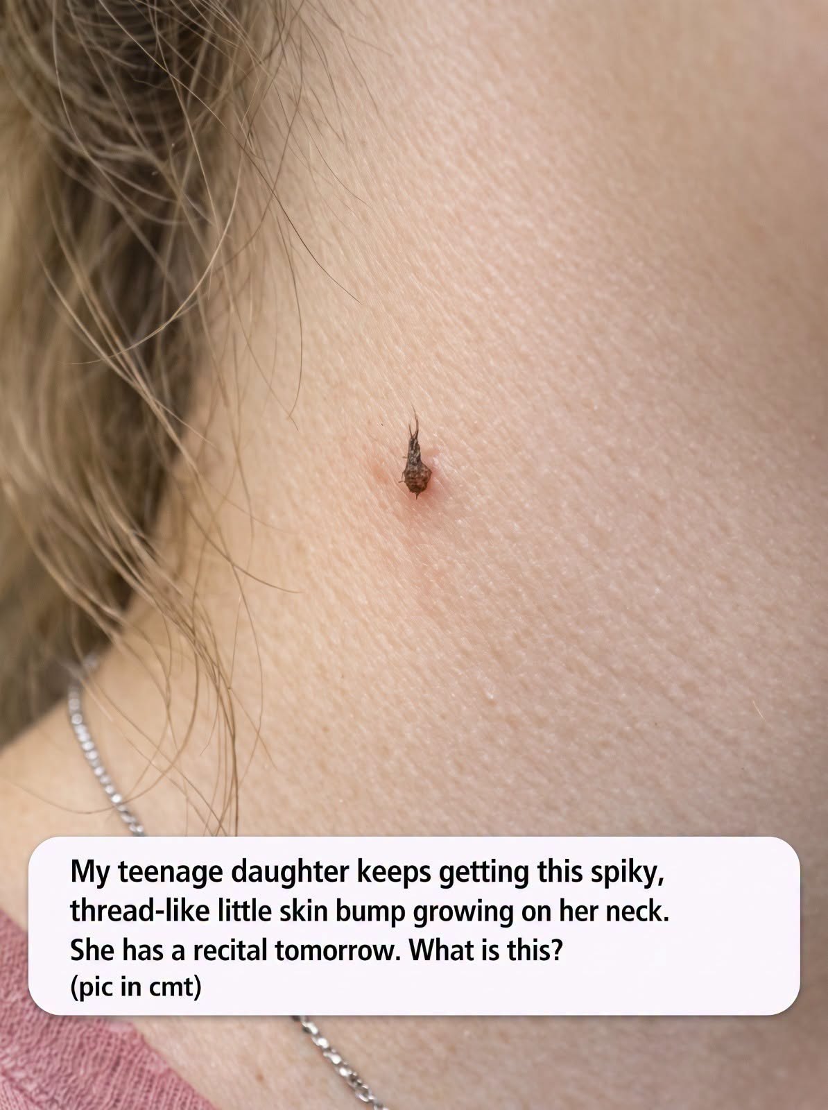 My teenage daughter keeps getting this spiky, thread-like little skin bump growing on her neck. She has a recital tomorrow. What is this?.