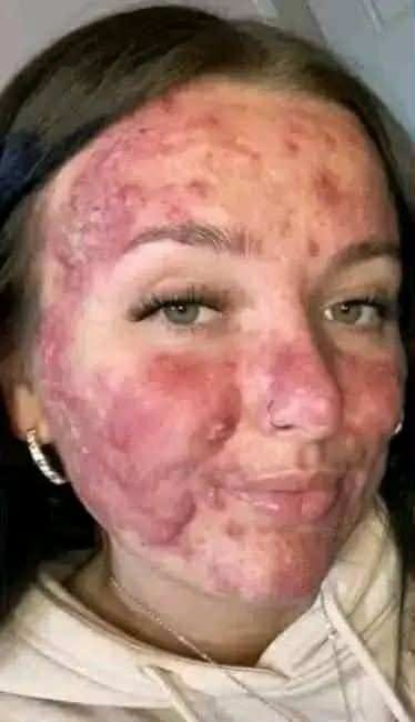 His whole body was itchy, he thought it was an allergy and was diagnosed…See more