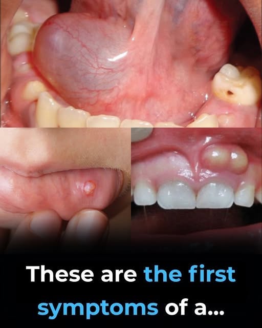 Early Warning Signs of Oral Health Problems: What Bumps and Swelling in the Mouth May Mean