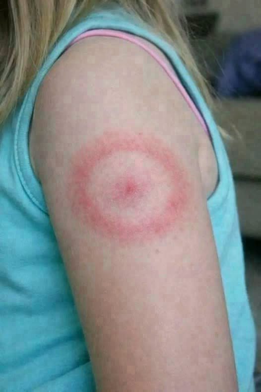 The Truth About Ringworm: What Causes It, How It Spreads, and How to Treat It
