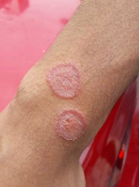 Hand Dermatitis Symptoms Causes and Everyday Care